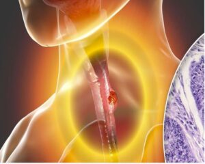 Cáncer de cuello