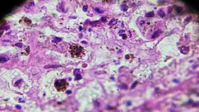 Dermatitis y Cáncer de piel