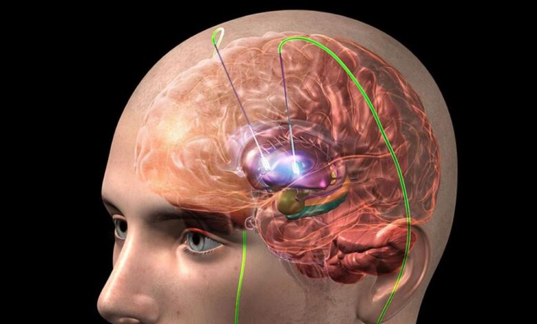 Estimulaciòn para pacienes con Parkinson