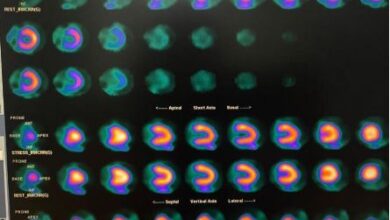 Estudio de Gammagrafía